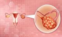 Scientist develops new model for ovarian cancer -- with crossover to uterine cancer