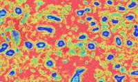 NIH researchers discover tissue biomarker that may indicate higher risk of aggressive breast cancer development and death